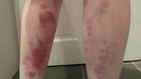 bruises2